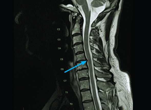 MRI Cervical Spine