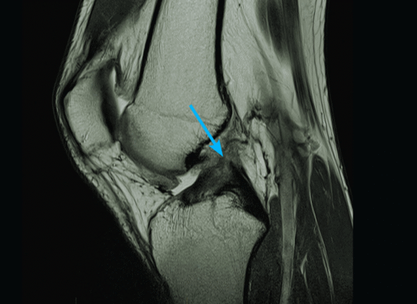 MRI Knee