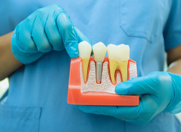 Root Canal Treatment